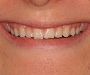 Before & Afters  - The Premier Dental Team