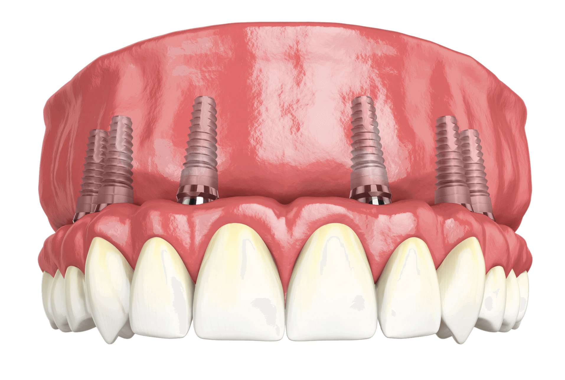 full arch dental implant