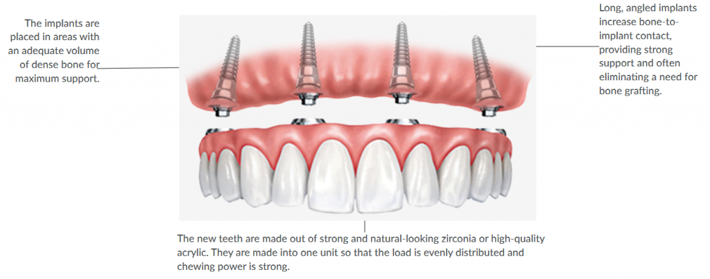 Diagram of all-on-four teeth replacement.